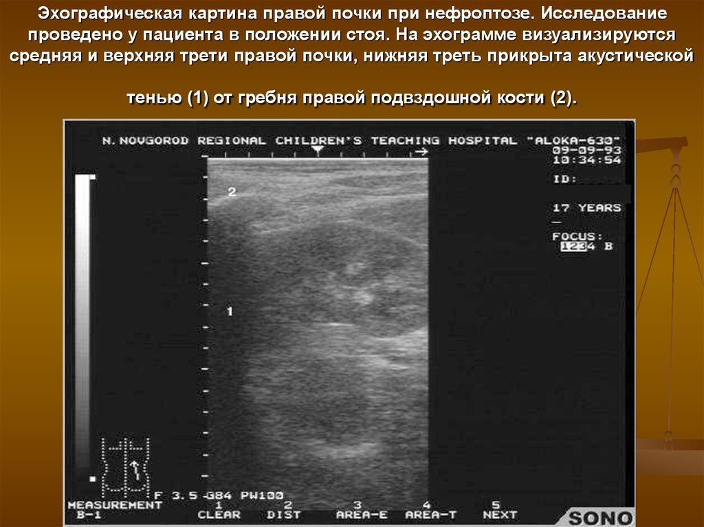 Эхографическая картина почек