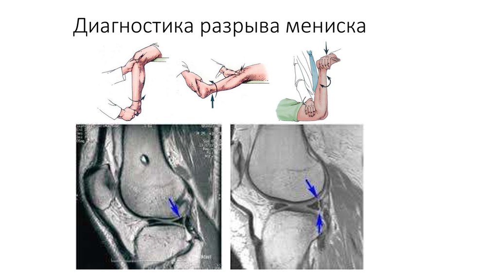 Повреждение мениска