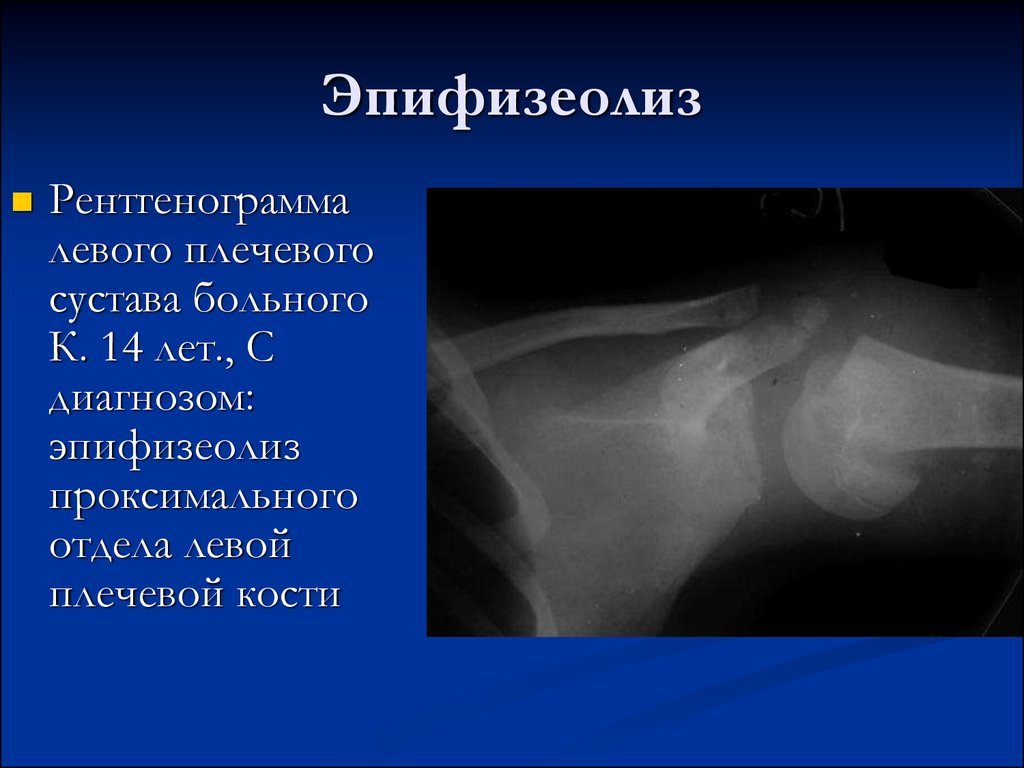 Эпифизеолиз это. Эпифизеолиз (перелом Салтера-Харриса);. Эпифизеолиз локтевого сустава рентген. Эпифизеолиз лучевой кости рентген. Эпифизеолиз головки плечевой кости.