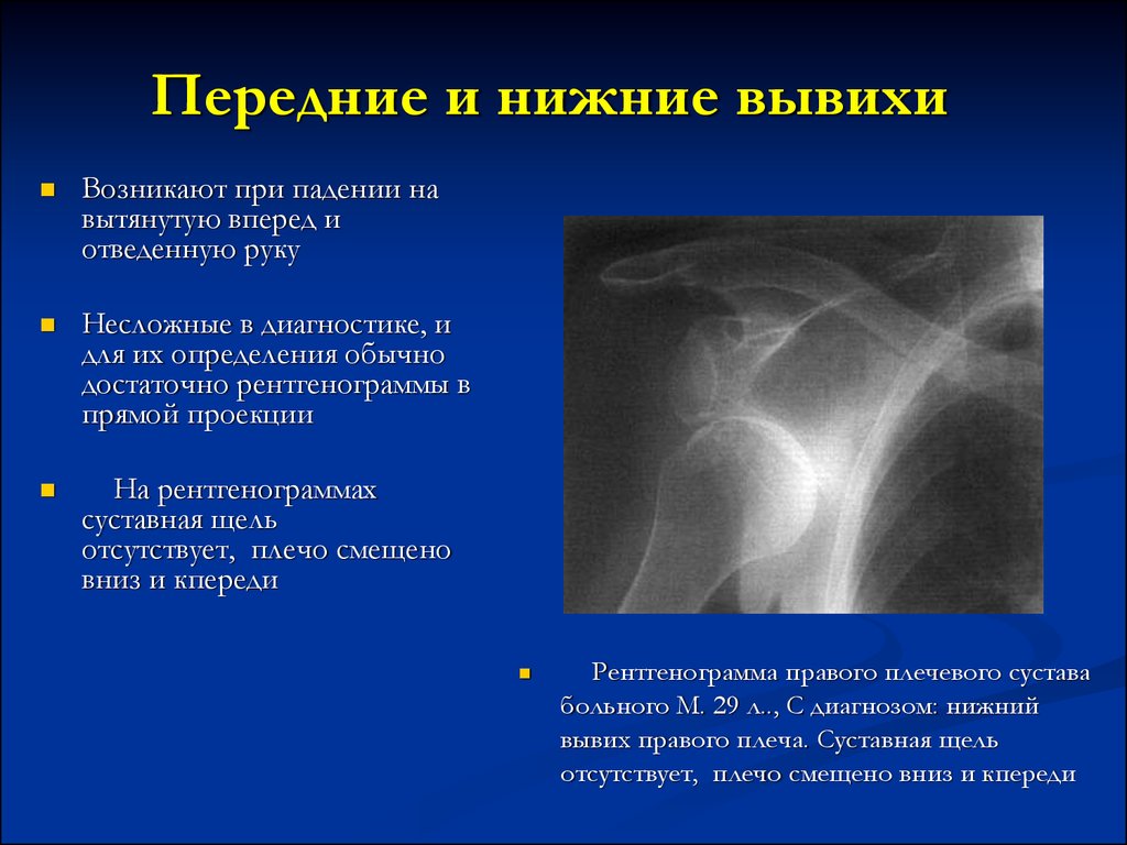 Передне нижний. Вывих плечевого сустава рентген описание. Подвывих плечевого сустава рентген описание. Подвывих головки плечевой кости рентген. Вывих головки плечевой кости классификация.