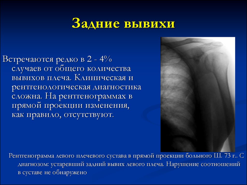 Вывих плеча мкб 10. Задний подвывих плеча рентген. Симптомы травматического вывиха плеча. Задний вывих плечевого сустава. Вывих плечевого сустава рентгенограмма.