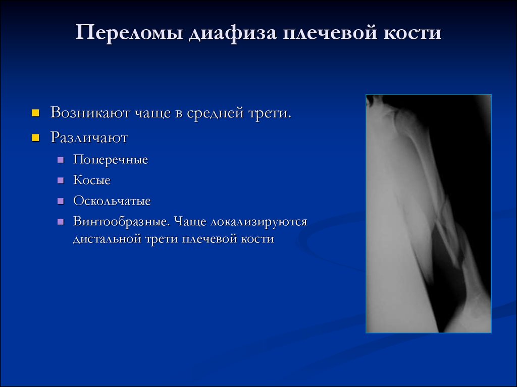 Треть кости. 3. Клиника перелома диафиза плечевой кости.. Перелом диафиза плеча классификация. Переломы диафизп Плеа классфиуация. Классификация переломов диафиза плечевой кости.