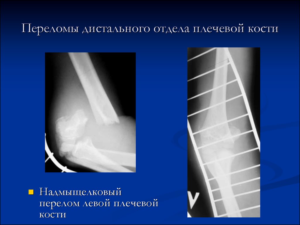 Открытый перелом плечевой кости карта вызова