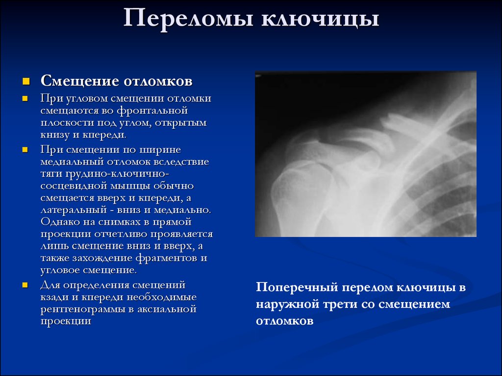 Переломы ключицы презентация