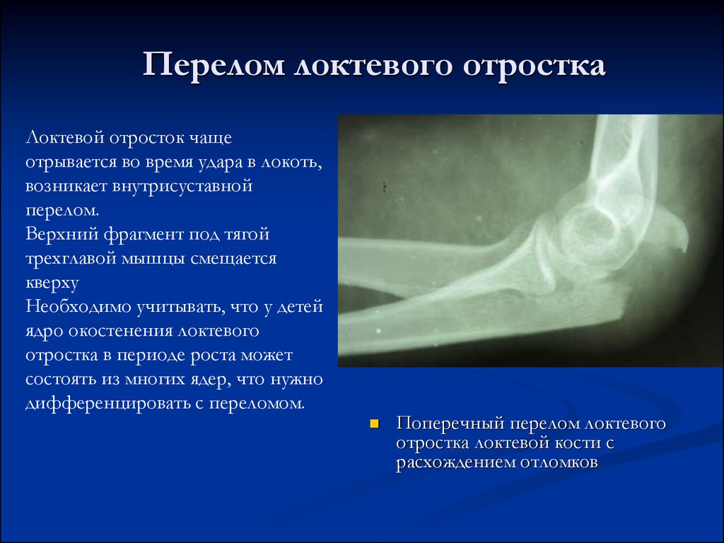Травма костной ткани. Перелом локтевого отростка со смещением рентген. Перелом локтевого отростка рентген. Перелом локтевого отростка локтевой кости рентген. Переломы плечевой кости в локтевом суставе рентген.