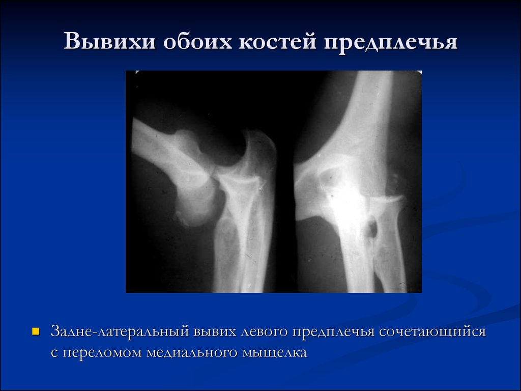 Вывих кости. Вывих костей предплечья в локтевом суставе. Передний вывих предплечья рентген. Травматический вывих предплечья. Вывих костей предплечья рентген.