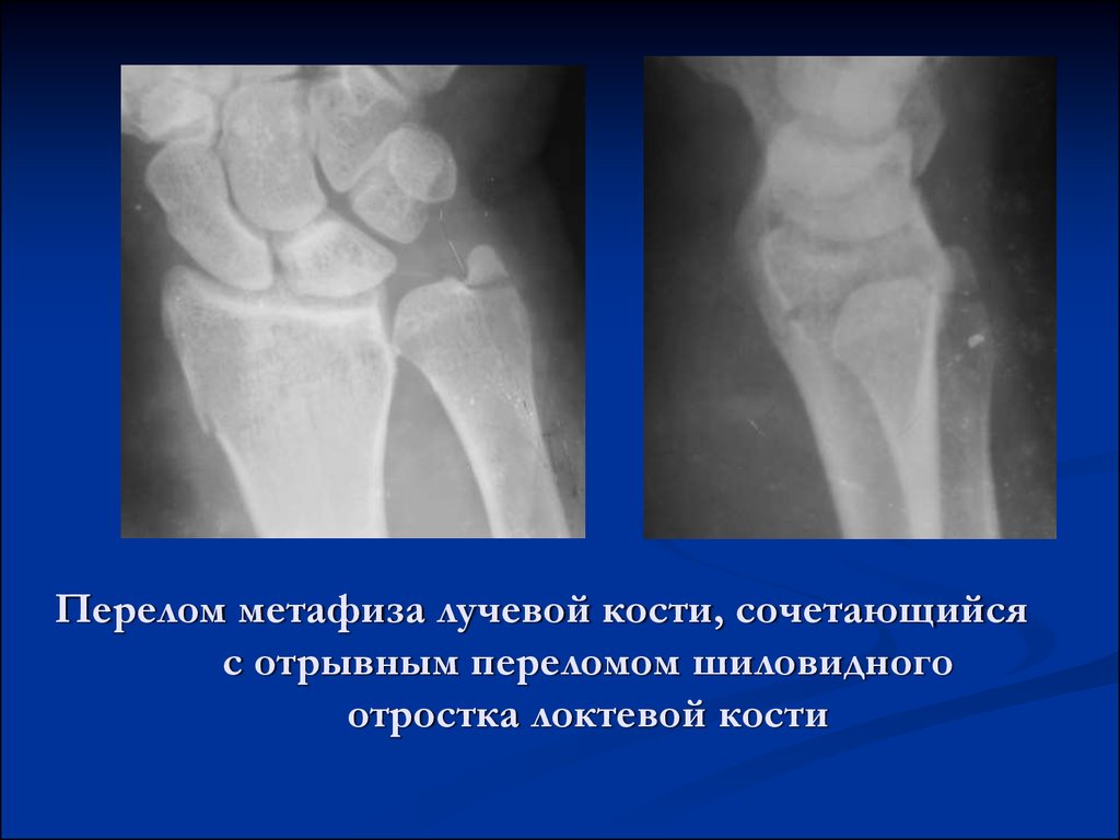 Перелом локтевой кости карта вызова скорой медицинской