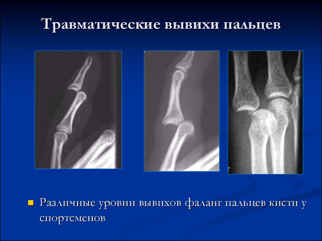 Переломы и вывихи костей предплечья и кисти презентация