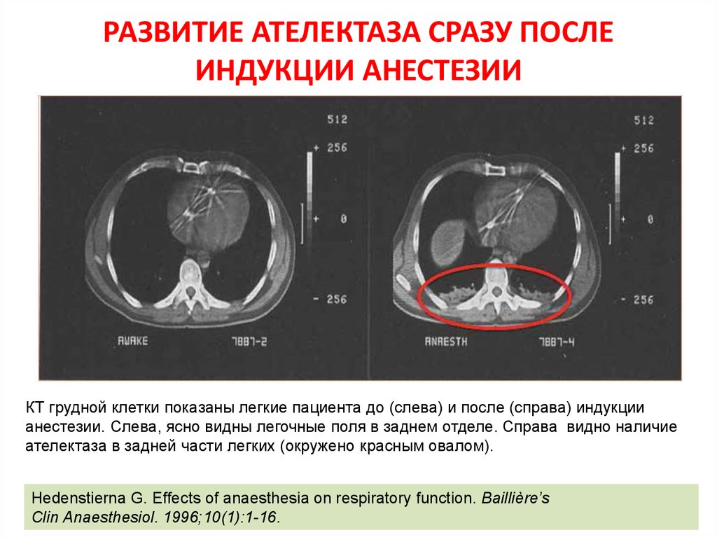 Кт легких акция