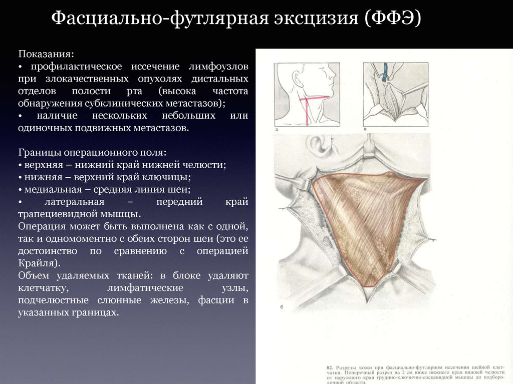 Эксцизия это. Операция Крайля ход операции.