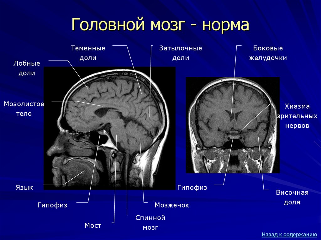 Мрт головного мозга презентация