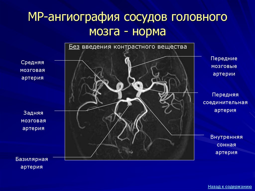 МР-ангиография сосудов головного мозга - норма