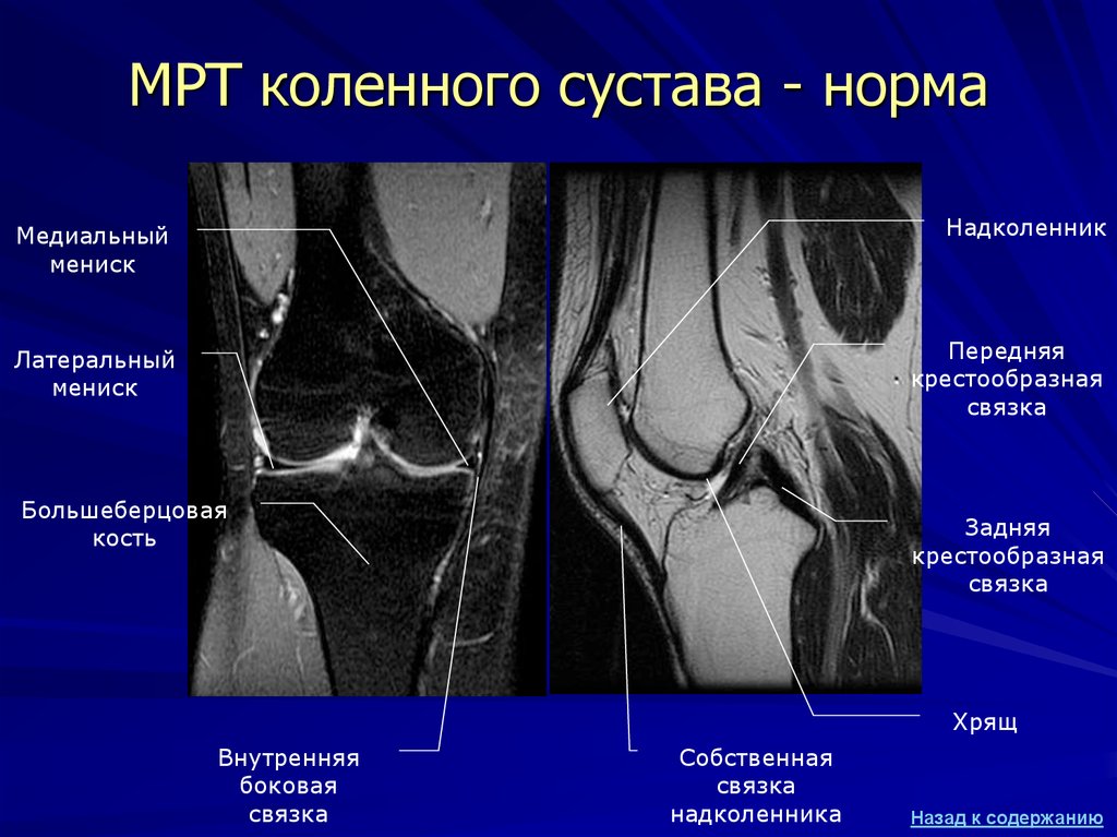 МРТ коленного сустава - норма