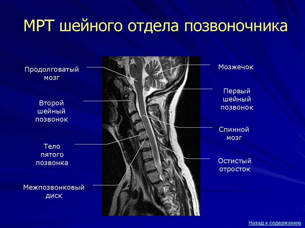 Отделы позвоночника для мрт схема