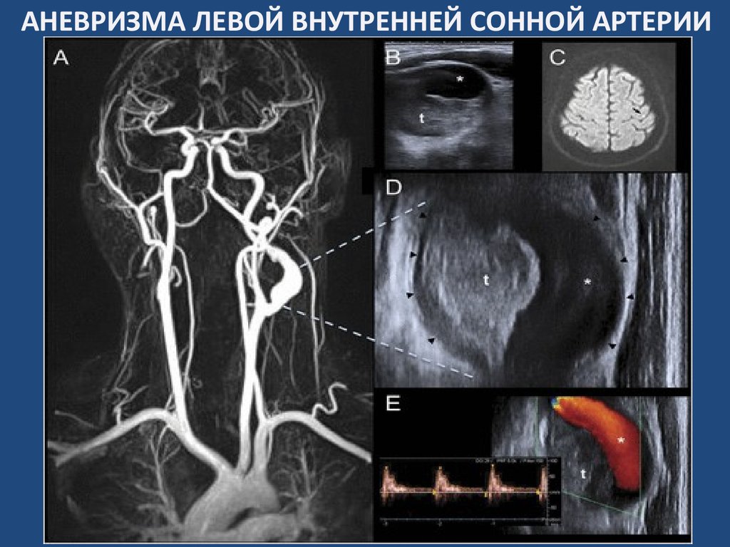 Аневризма сонной артерии что это. Мешотчатая аневризма ВСА. Аневризма с4 сегмента левой ВСА. Кт ангиография аневризма внутренней сонной артерии. Аневризма супраклиноидного сегмента левой ВСА.