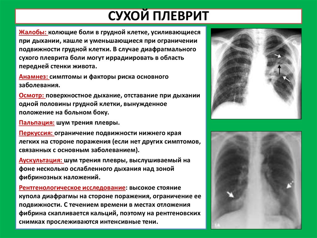 Какая аускультативная картина характерна для сухого плеврита