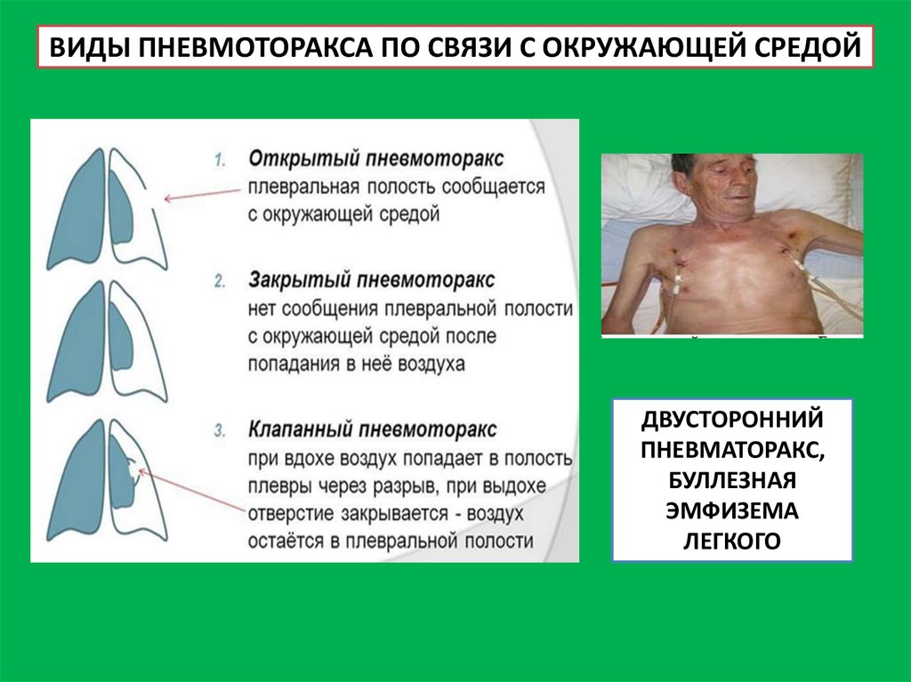 Клиническая картина открытого пневмоторакса