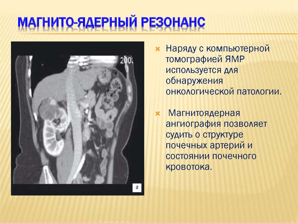 Патология почек. Магнитный резонанс в медицине. Ядерный магнитный резонанс в медицине. Акустический резонанс в медицине. Польза резонанса в медицине.