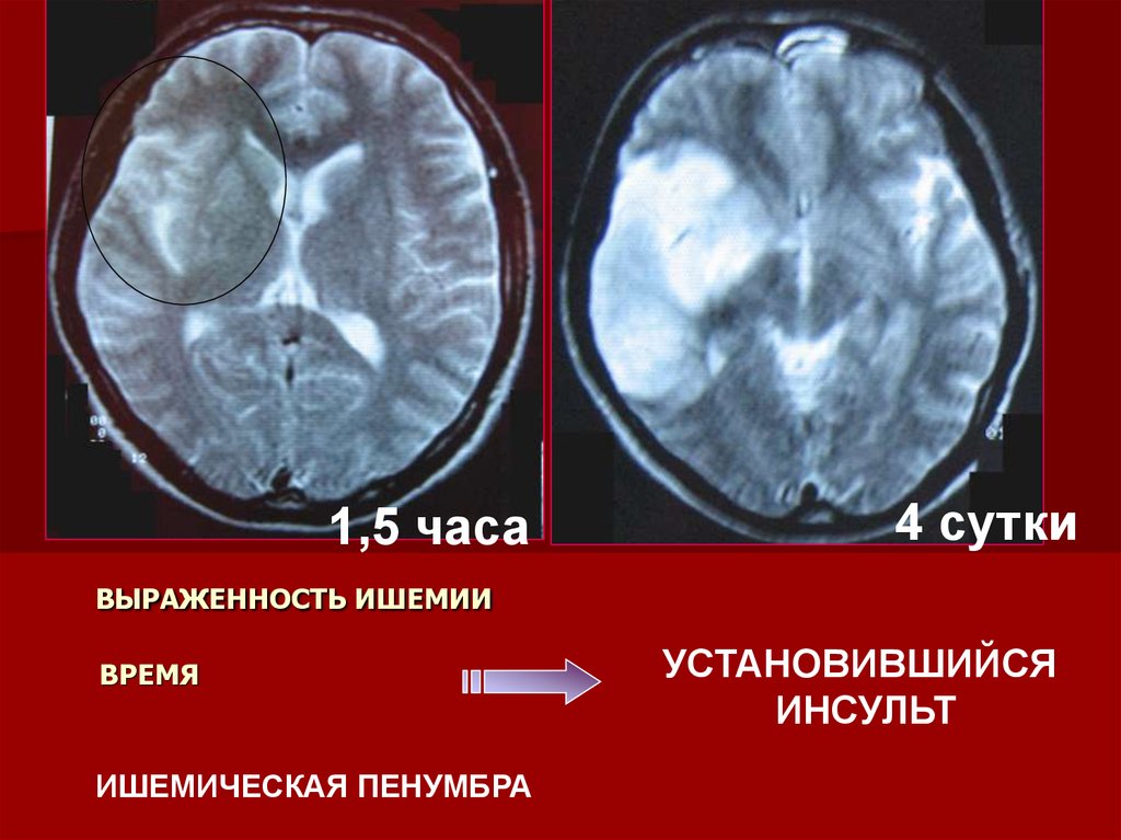 Ишемия мозга мрт. Ишемический инсульт на кт головного мозга. Ишемический инсульт мрт. Геморрагический инсульт головного мозга кт.