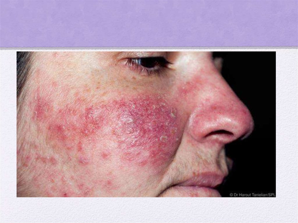VIRTUAL GRAND ROUNDS IN DERMATOLOGY 2.0: Rosacea-Like ...