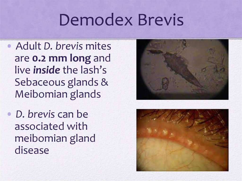 Demodex Mites презентация онлайн