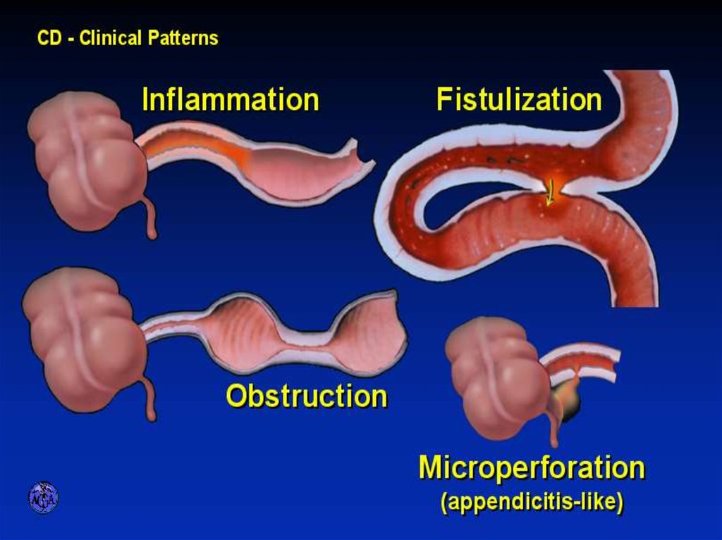 Inflammatory Bowel Diseases - online presentation