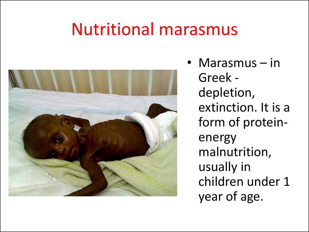 Nutritional marasmus
