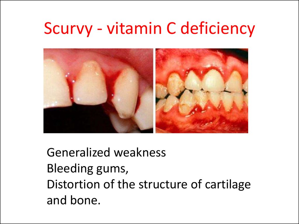 Scurvy - vitamin C deficiency