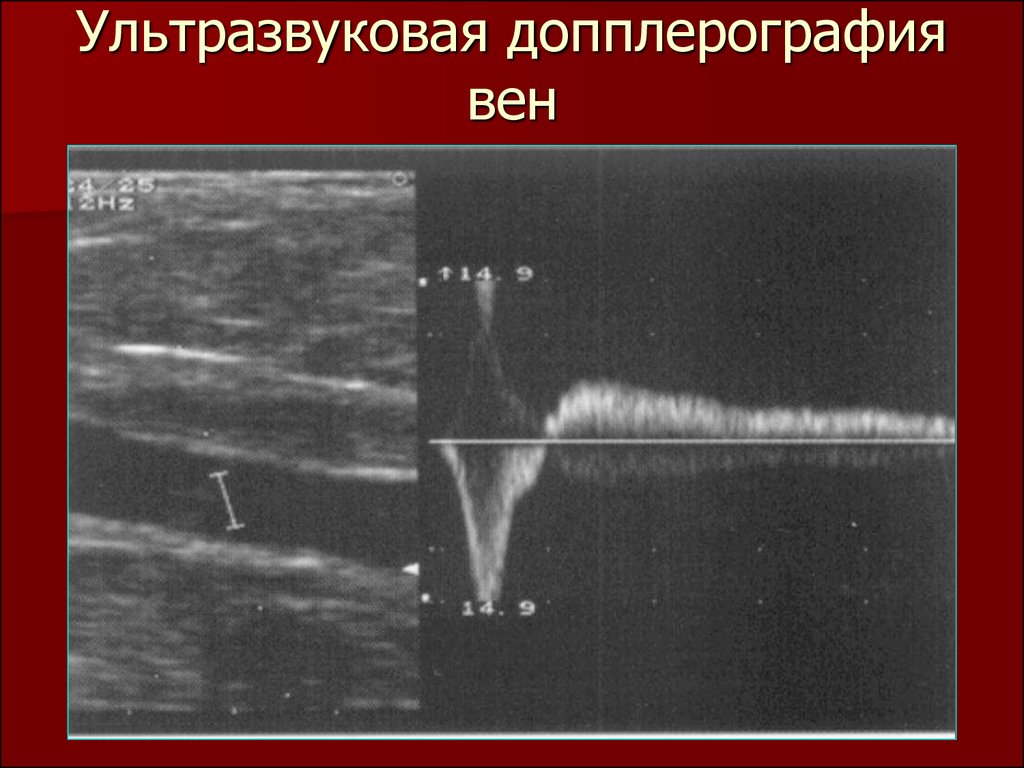 Ультразвуковая допплерография. Тромбоз вен допплерография. Допплерография при атеросклерозе нижних конечностей. Допплерография при варикозе снимок. УЗДГ тромбофлебит презентация.