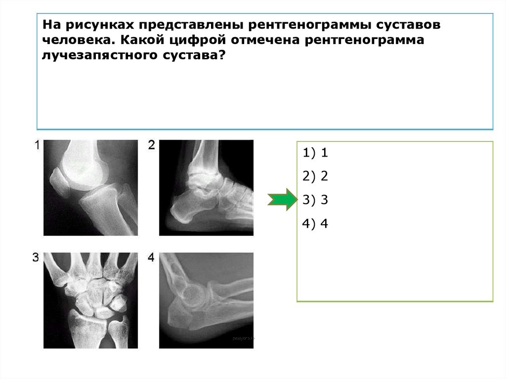 На рисунках представлены рентгенограммы суставов человека какой цифрой отмечена рентгенограмма