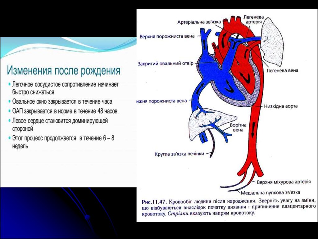 Легочное кровообращение. Пороки сердца с гиперволемией малого круга. Гиперволемия малого круга кровообращения. Открытый артериальный проток заключение. Открытый артериальный проток и овальное окно схема.