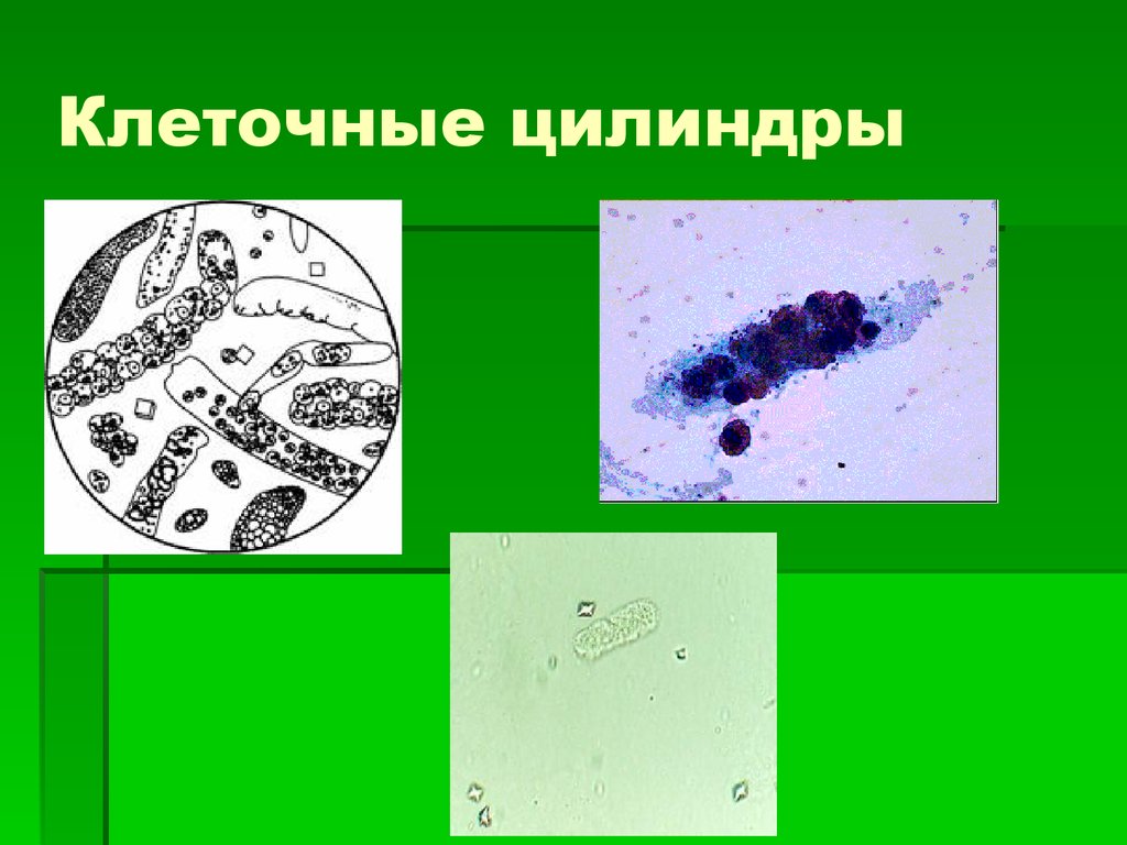 Цитология мочи. Клеточные цилиндры. Строение клетки цилиндр.