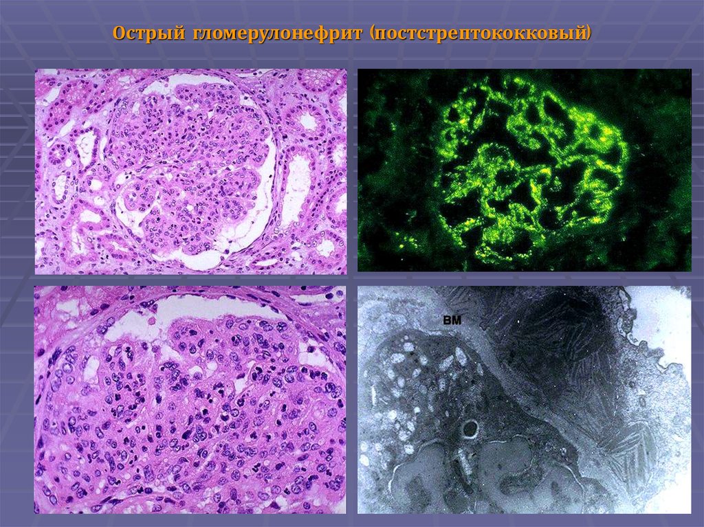 Острый гломерулонефрит микроскопическая картина