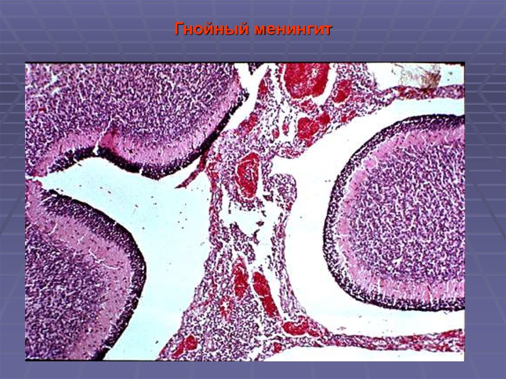 Воспаления головного. Гнойный менингит микропрепарат. Гнойный менингит патоморфология. Гнойный менингит микропрепарат патанатомия. Менингококковый Гнойный менингит микропрепарат.