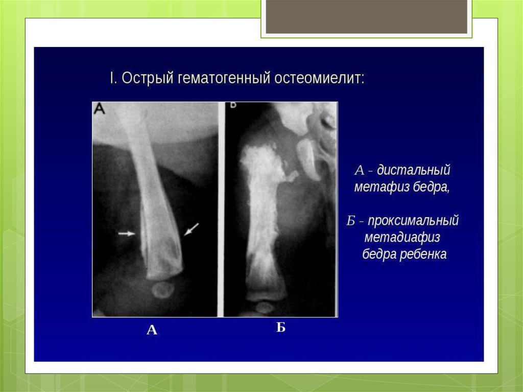 Остеомиелит у детей. Острый гематогенный метаэпифизарный остеомиелит. Эндогенный остеомиелит. Эпифизарный остеомиелит новорожденного. Острый гематогенный остеомиелит бедренной кости рентген.
