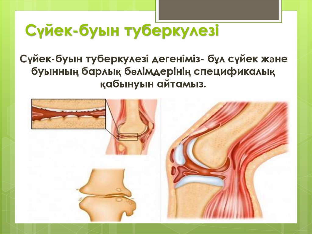 Буын синдромы презентация