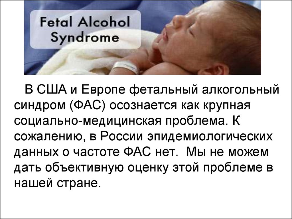 Фетально алкогольный. Фетальный алкогольный синдром. Дети с синдромом алкогольного плода.