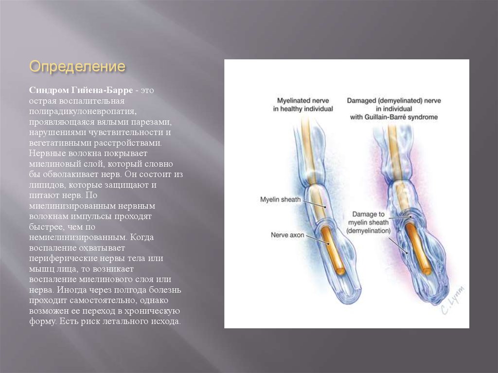 Гийена барре неврология. Полирадикулонейропатия Гийена-Барре. Полинейропатия Гийена Барре патогенез. Острая воспалительная полирадикулоневропатия Гийена-Барре. Синдром Гийена Барре этиология.