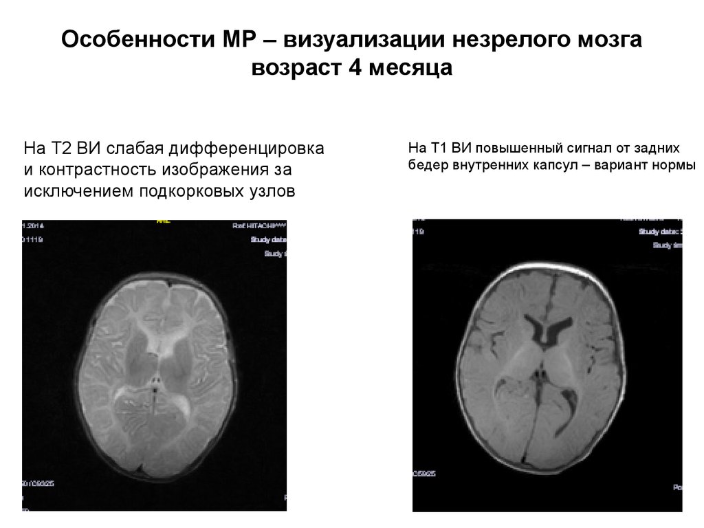 Возраст мозга 2. Возраст мозга. Незрелый мозг у ребенка. Особенности МР-изображения. Мозг по возрасту незрелый.