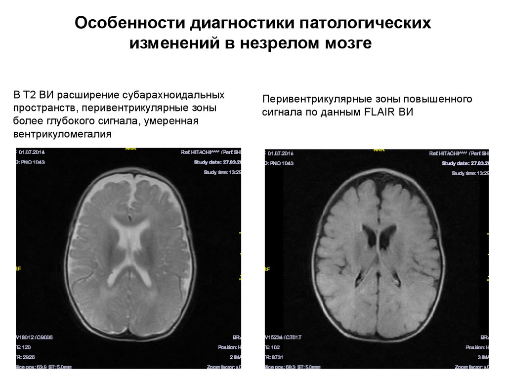 Расширение ликворных пространств головного мозга