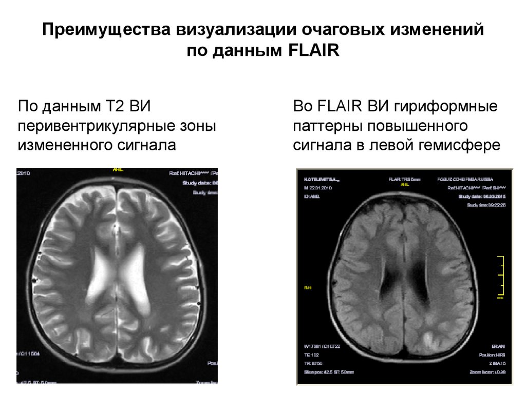 Мр картина образования. Перивентрикулярная зона. Гиперинтенсивный сигнал на Flair. Очаги повышенного сигнала по т2 ви Flair,. Диффузное повышение сигнала по т2 ви.