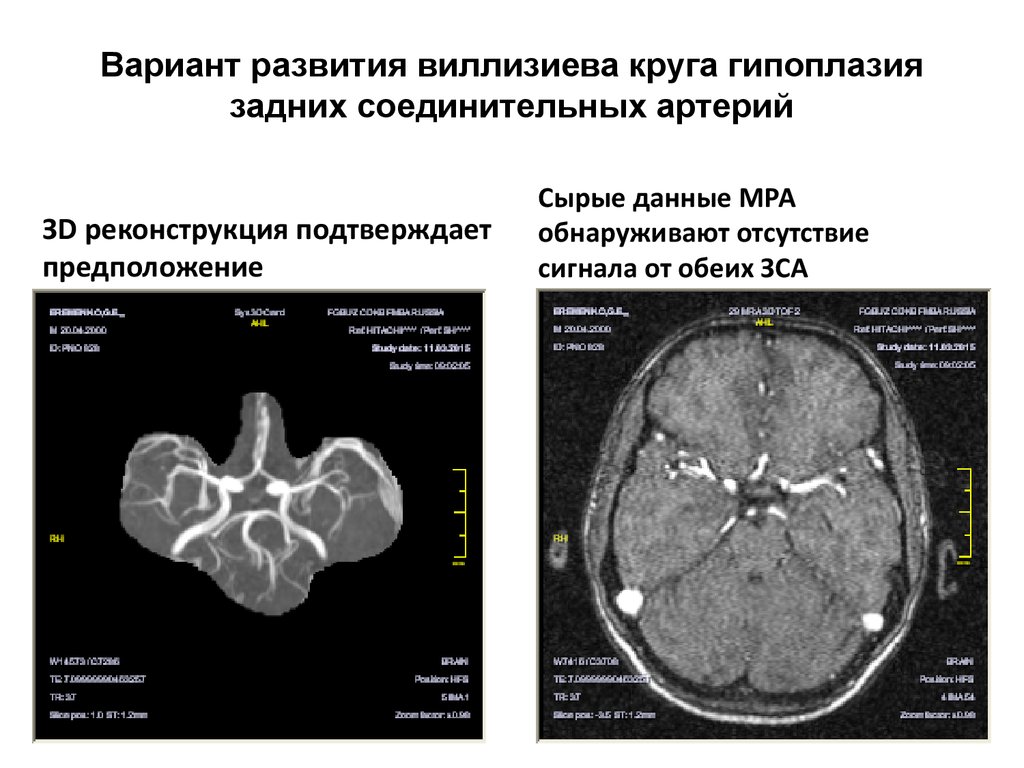 Гипоплазия правой артерии головного мозга. Варианты строения Виллизиева круга мрт. Что такое вариант развития Виллизиева круга в головном мозге. Мрт сосудов головного мозга Виллизиев круг. Вариант развития Виллизиева круга головного.