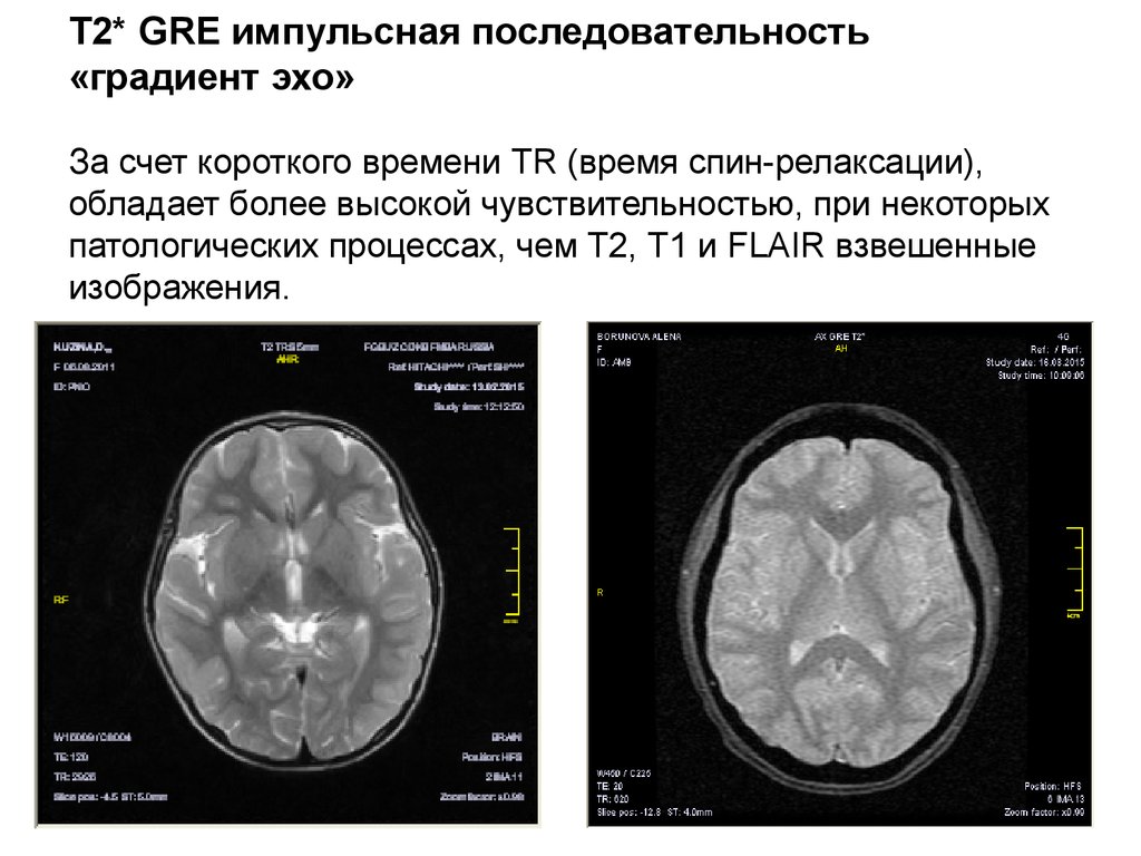 Т1 и т2 взвешенные изображения в мрт