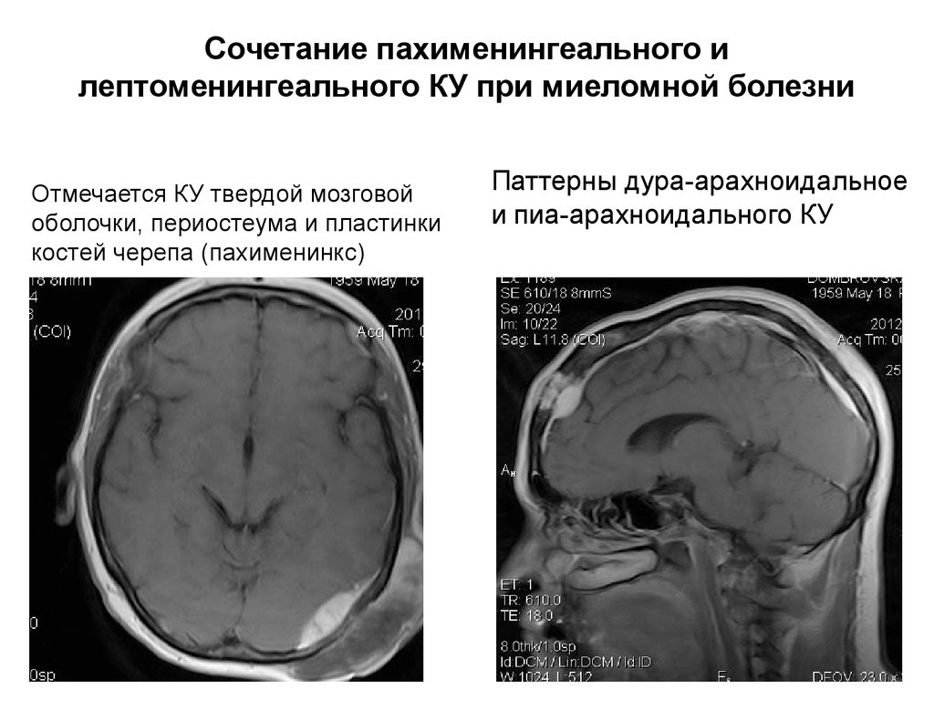 Арахноидальная киста мозга