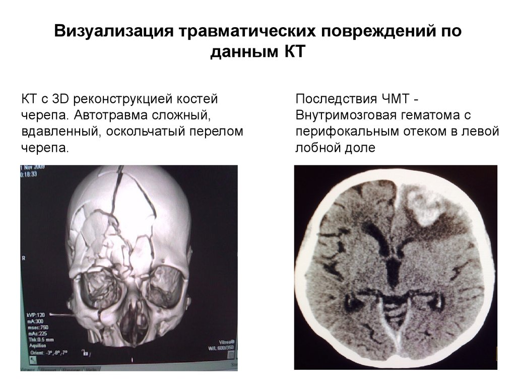 Расширение субарахноидального