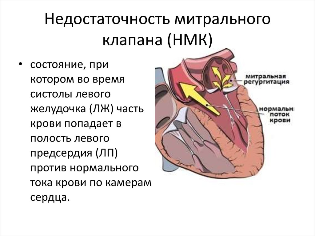 Сердечная недостаточность митрального клапана. Недостаточность митрального клапана 1. Недостаточность митрального клапана 2 степени сердце. Недостаточность митрального клапана структура. Пороки сердца недостаточность митрального клапана.