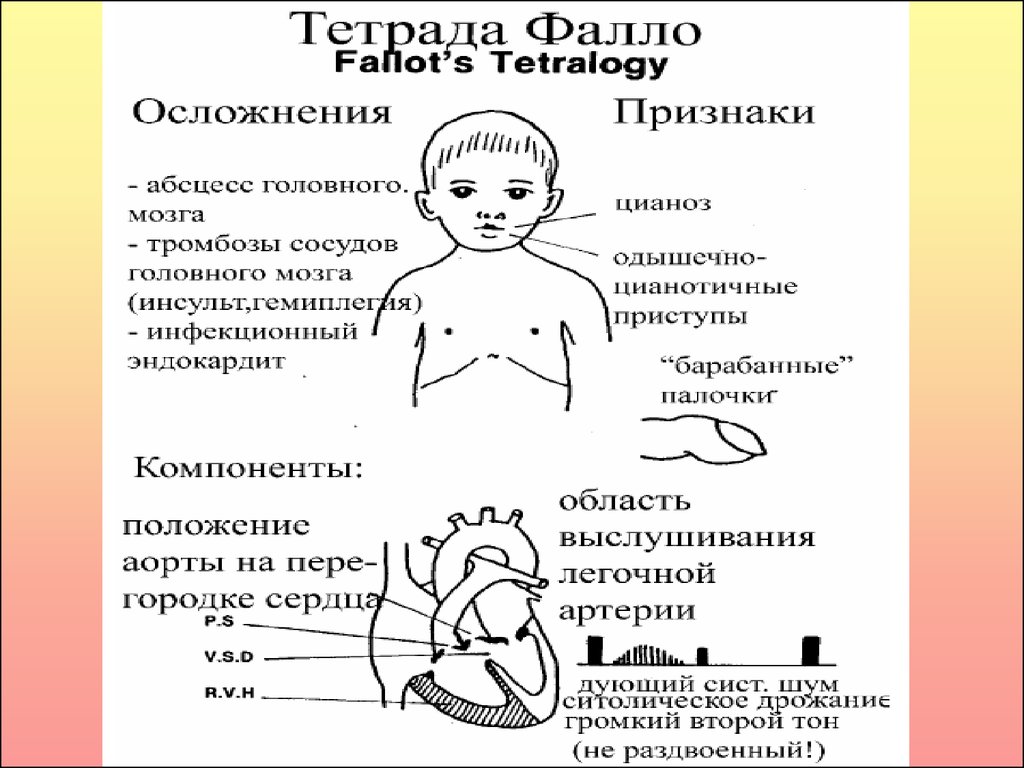 Доклад по теме Одышечно-цианотичные приступы у детей. Осложнения и лечение тетрады Фалло