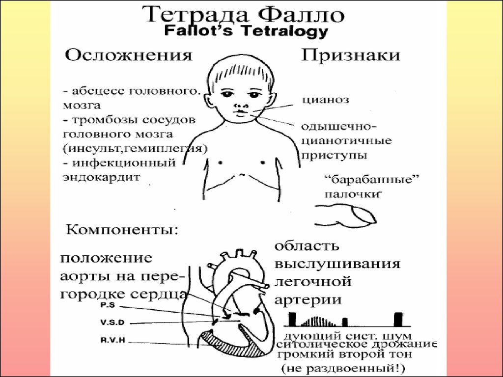 Тетрада фалло у детей