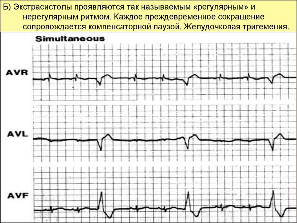 Нерегулярность ритма сердца процентах. Сливные экстрасистолы. Ранние желудочковые экстрасистолы типа r на t. Регулярный и нерегулярный ритм. Схема экстрасистолы и компенсаторной паузы.