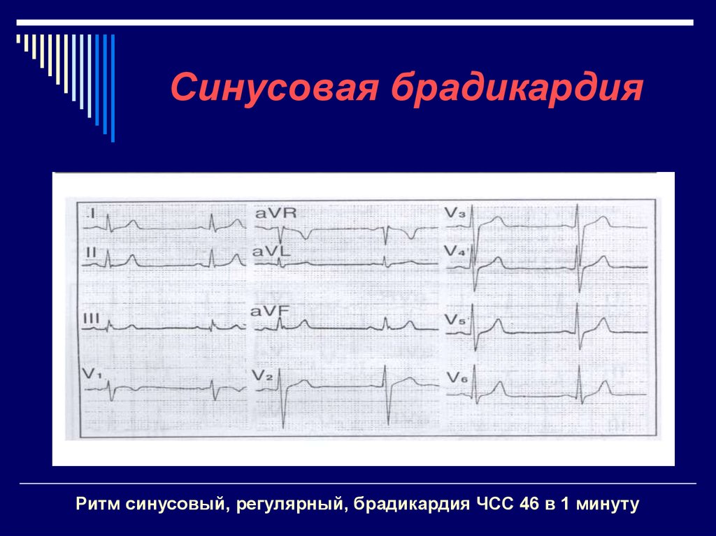 Синусовая брадикардия горизонтальная. Синусовый ритм. Брадикардия. Синусоидальная брадикардия. Регулярный синусовый ритм. Синусовая брадикардия сердца.